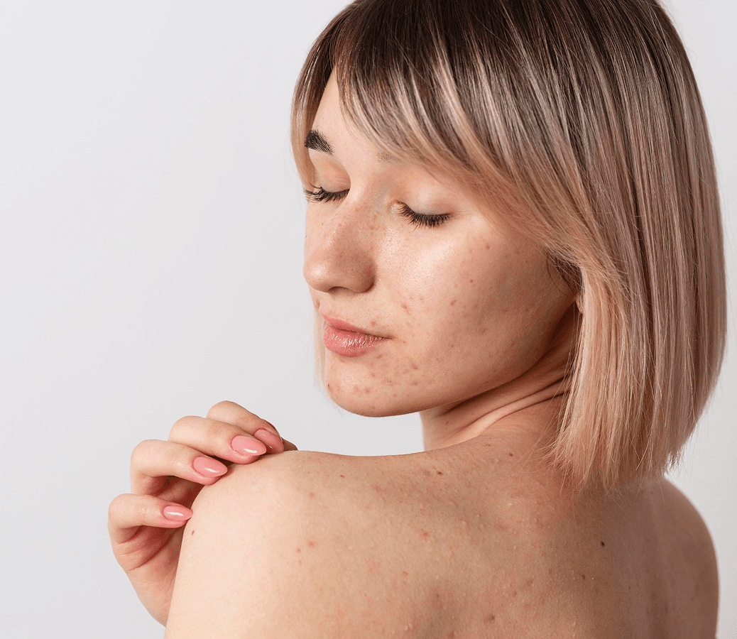 close-up-smiley-woman-with-acne
